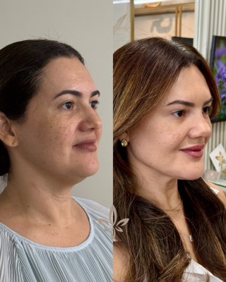 Antes e depois de paciente