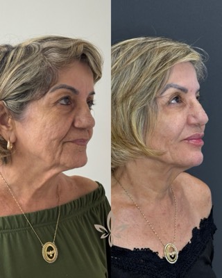 Antes e depois de paciente