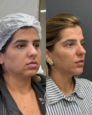 Antes e depois de paciente