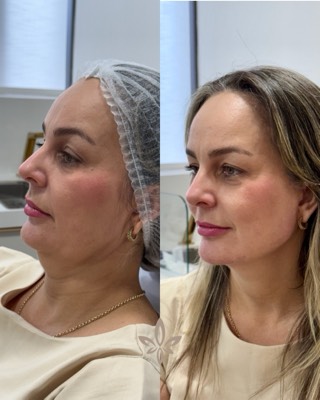 Antes e depois de paciente