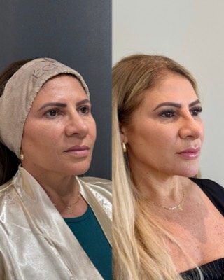 Antes e depois de paciente