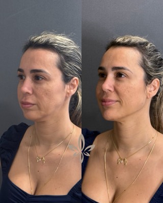 Antes e depois de paciente